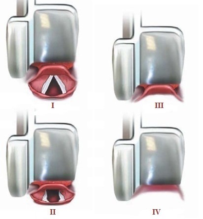 Cormack–Lehane grades I to IV at laryngoscopy