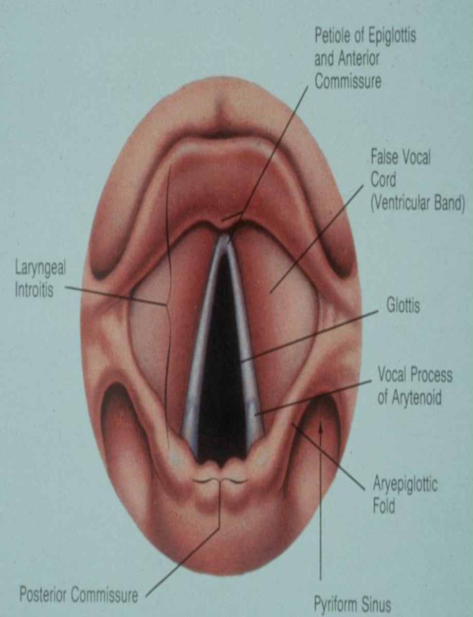Labelled laryngoscopic view of the glottis: epiglottis and anterior commissure above, true and false vocal cords, glottis, aryepiglottic folds, pyriform sinuses, arytenoid vocal processes and posterior commissure below