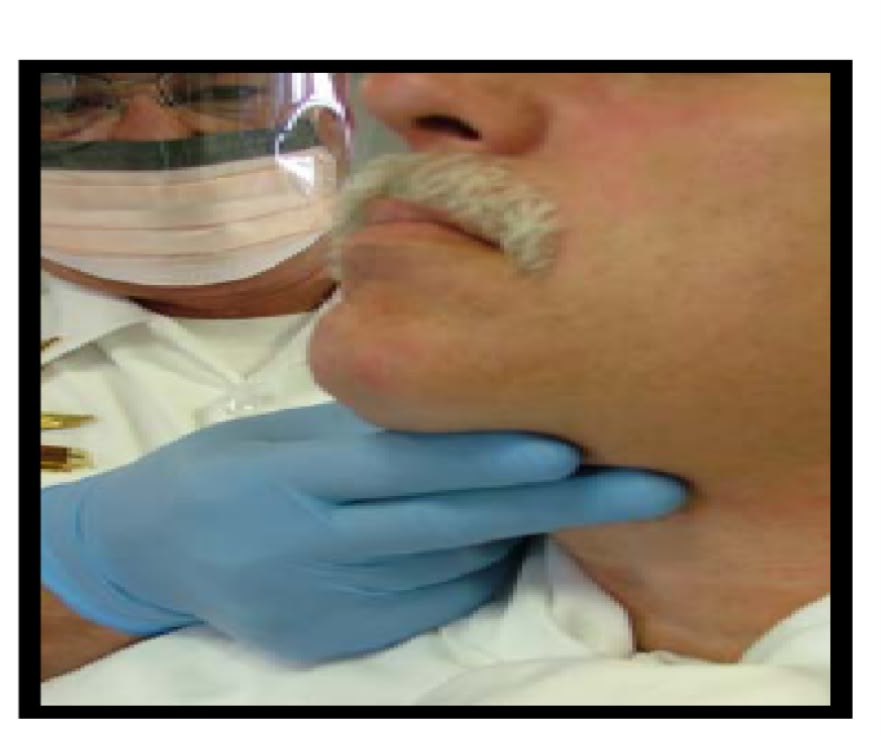 Measuring the thyromental distance — palpating from the thyroid notch to the chin with the neck extended