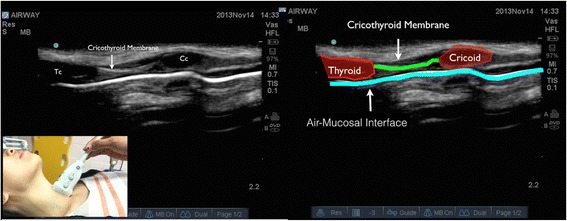 Longitudinal airway ultrasound showing the cricothyroid membrane between thyroid and cricoid cartilage