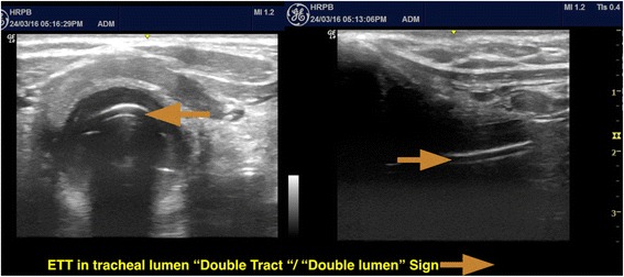 Airway ultrasound showing the endotracheal tube double-tract sign