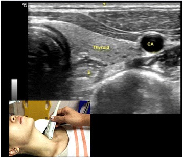 Transverse airway ultrasound showing the oesophagus lateral to the trachea
