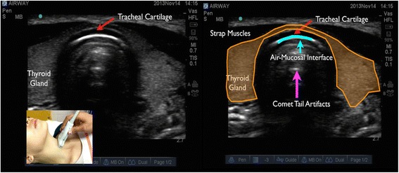 Transverse airway ultrasound at the trachea with comet-tail artefact