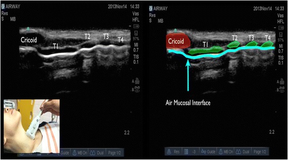 Longitudinal airway ultrasound showing tracheal rings as a string of beads