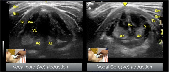 Transverse airway ultrasound of the vocal cords in abduction and adduction