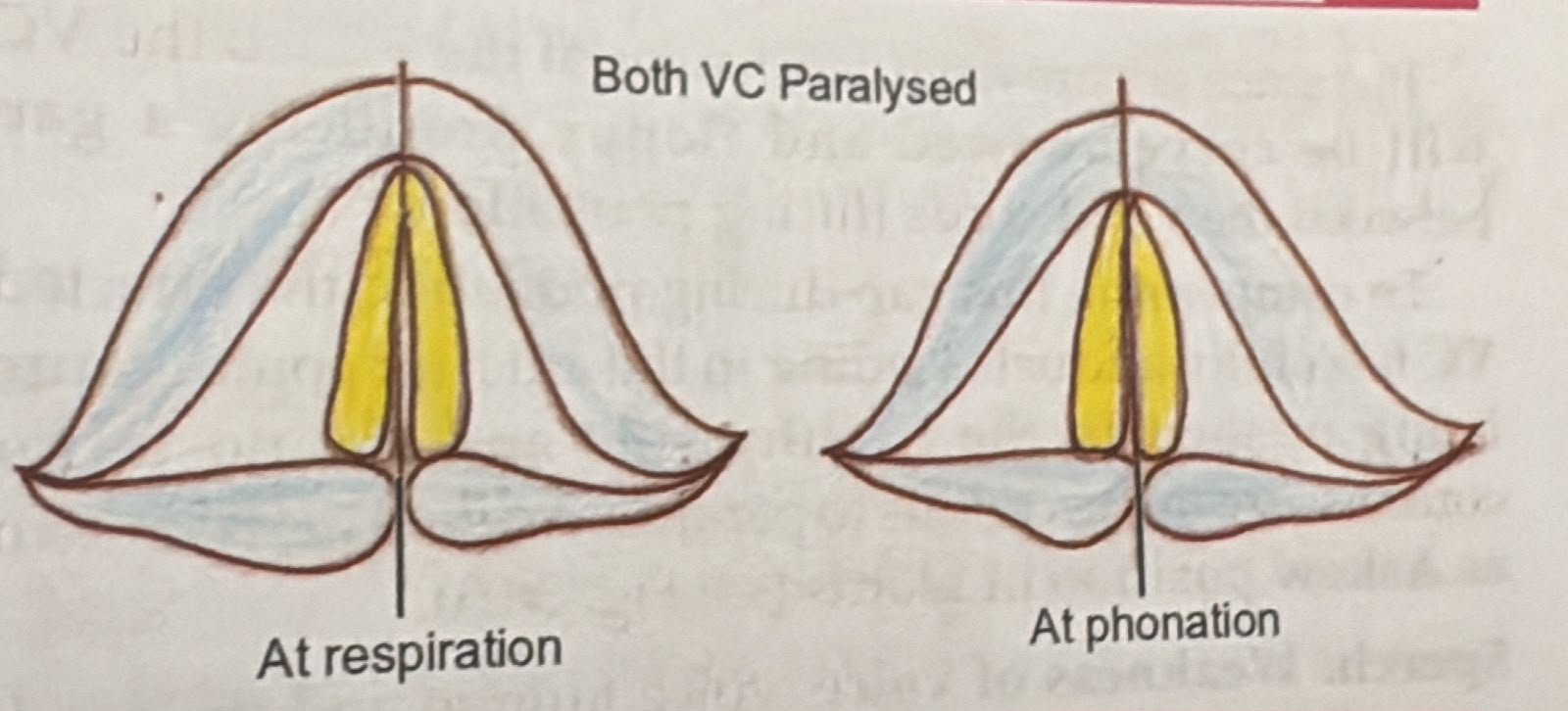 Bilateral RLN palsy at respiration and phonation — both cords fixed near the midline