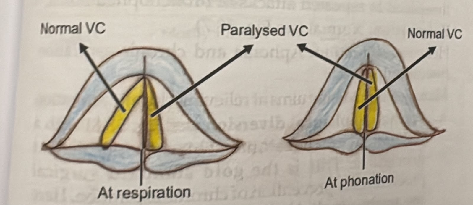 Unilateral RLN palsy at respiration and phonation — the paralysed cord sits paramedian while the normal cord moves