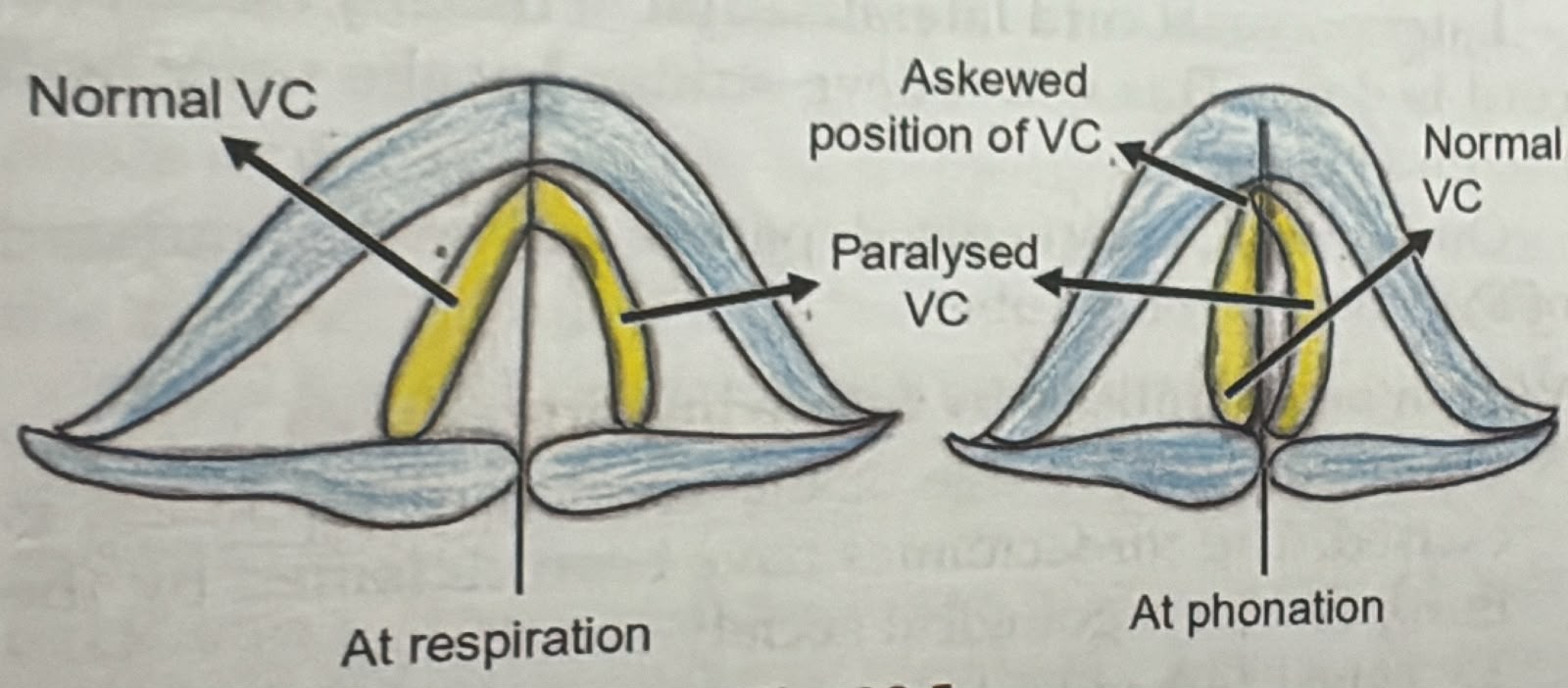 Unilateral SLN palsy: the affected cord is bowed and lax and the glottis is askewed at phonation