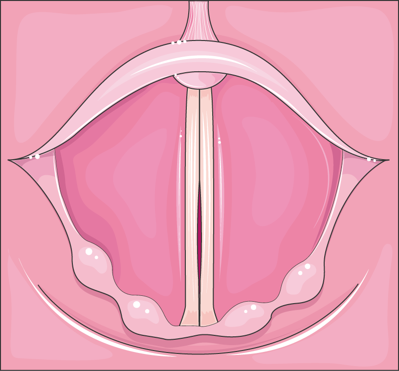 Laryngeal view of the vocal cords adducted in phonation